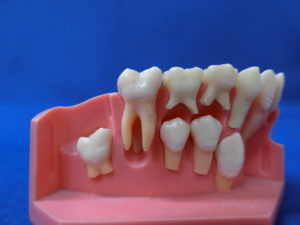 永久歯の交換模型